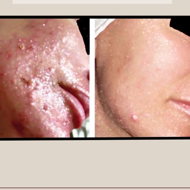 Pimple injection