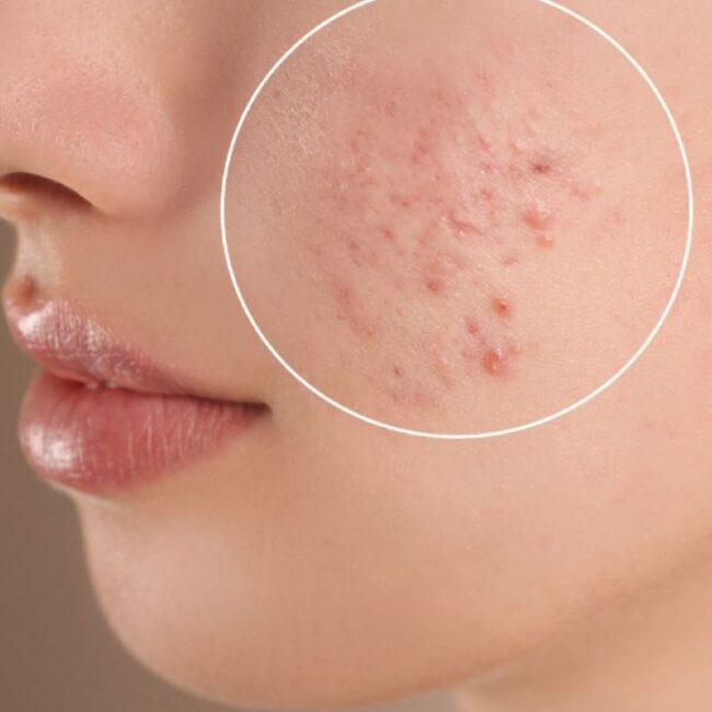 Scar Removal in Dubai