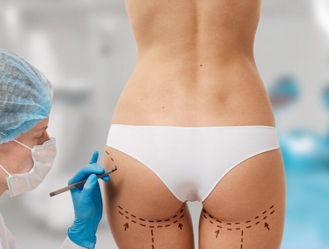 Buttlift Treatment