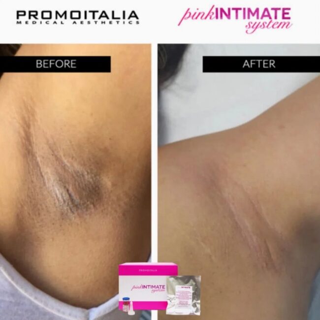 Italian Pink System for Intimate Whitening