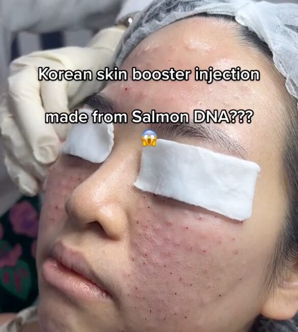 Salmon Sperm Injections