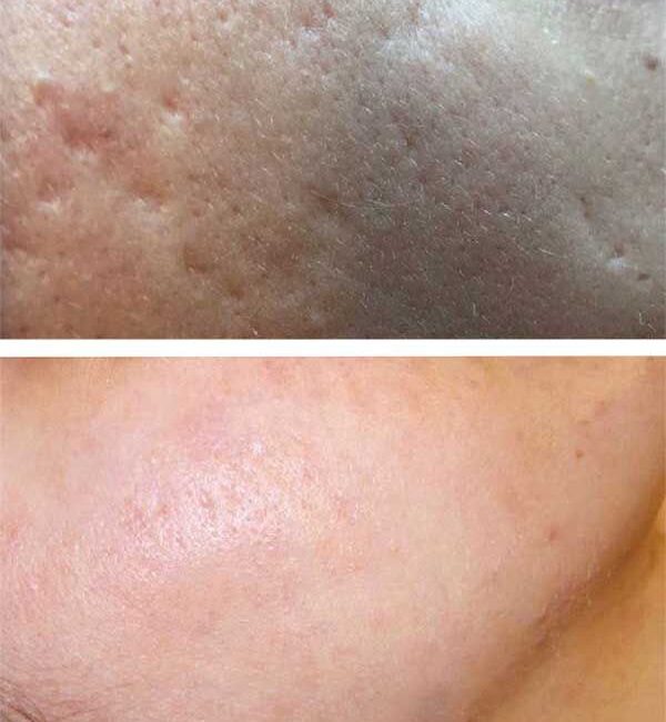 Discover Radiant Skin with Non-Ablative Erbium Nd:YAG Laser Treatments