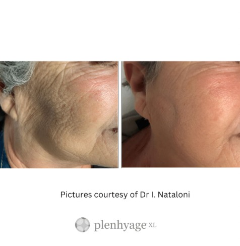 Plenhyage 50mg PDRN: The Strongest Salmon DNA Treatment for Skin Rejuvenation