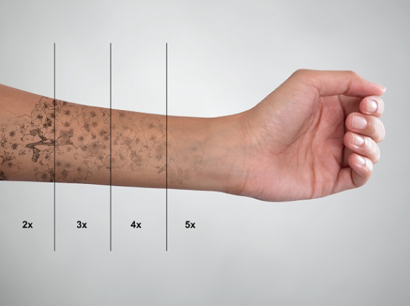 Laser Treatments in Dubai