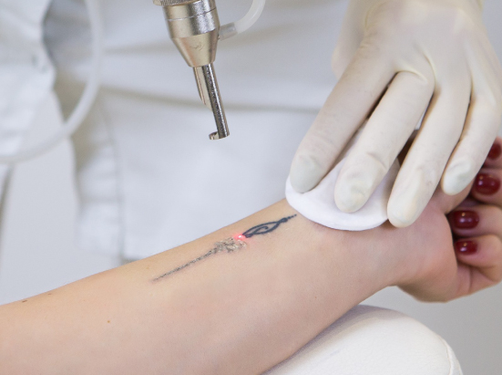 Laser Tattoo Removal in Dubai