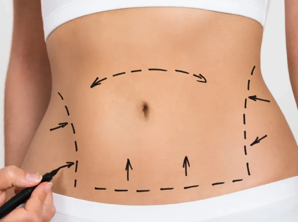 Fat Dissolving Injections in Dubai
