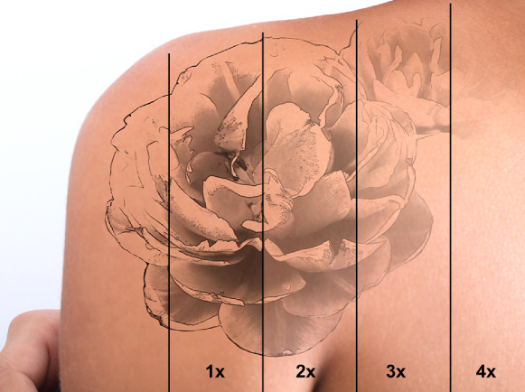 Laser Tattoo Removal in Dubai