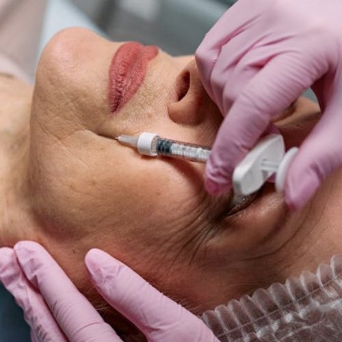 Dermal Filler Treatement